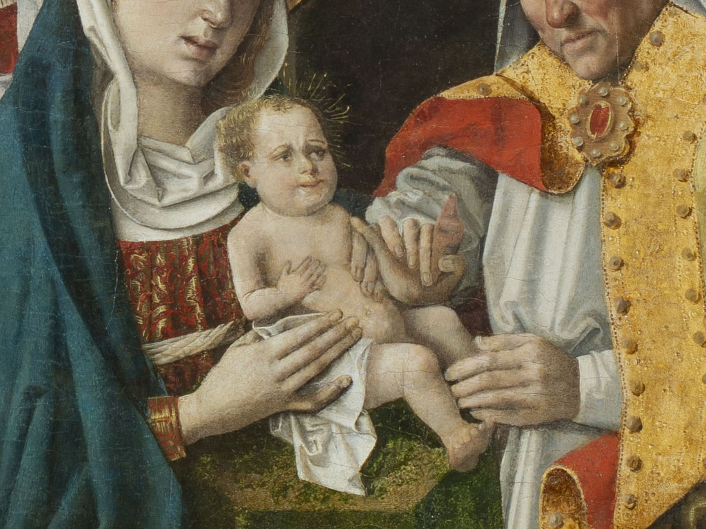 Circumcision: Surgical Removal of the Foreskin
